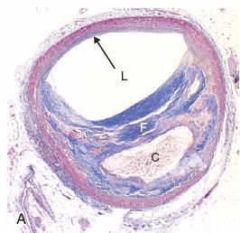 ATHEROSCLEROSIS Morphology: Atherosclerotic plaques have three principal components: (1) Cells, including smooth muscle cells, macrophages, and T cells (2) Extracellular matrix, including collagen,