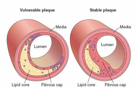 ATHEROSCLEROSIS Clinical Consequences: Unstable plaques can cause dramatic and potentially fatal ischemic complications related to acute plaque rupture, thrombosis, or embolization Stable plaques can