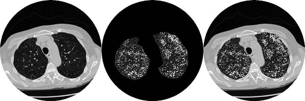 Figure 1: Sample emphysema index computed at -910 HU from a whole lung CT scan. Left: Standard axial CT slice.