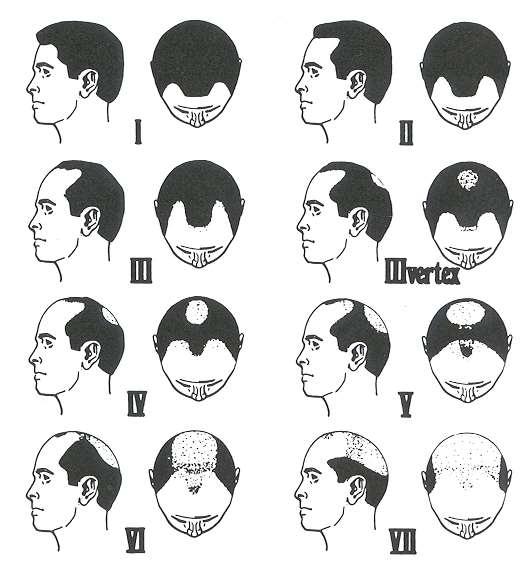 Facial Analysis Hairline
