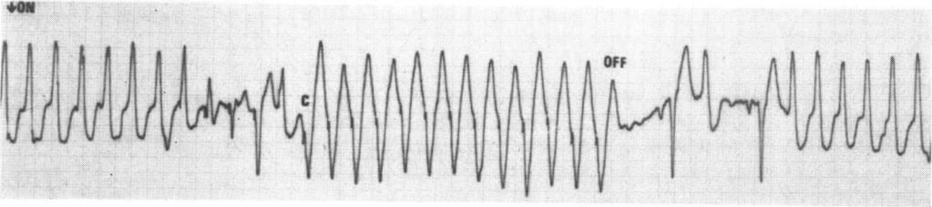 Pacing was reinstituted at 3 volts and 192 beats/min (Fig. i). This rate was 6 beats/min faster than the existing ventricular tachycardia.