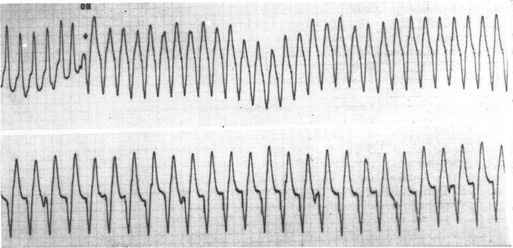 924 Bennett and Pentecost FIG. 2 Case i. Pacing restarted (on) at 192 beats/min with immediate ventricular capture.