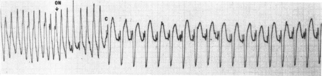 Case 4 This patient was already in ventricular tachycardia on admission to the Coronary Care Unit. He was a 65-year-old man with an acute anterior infarction.