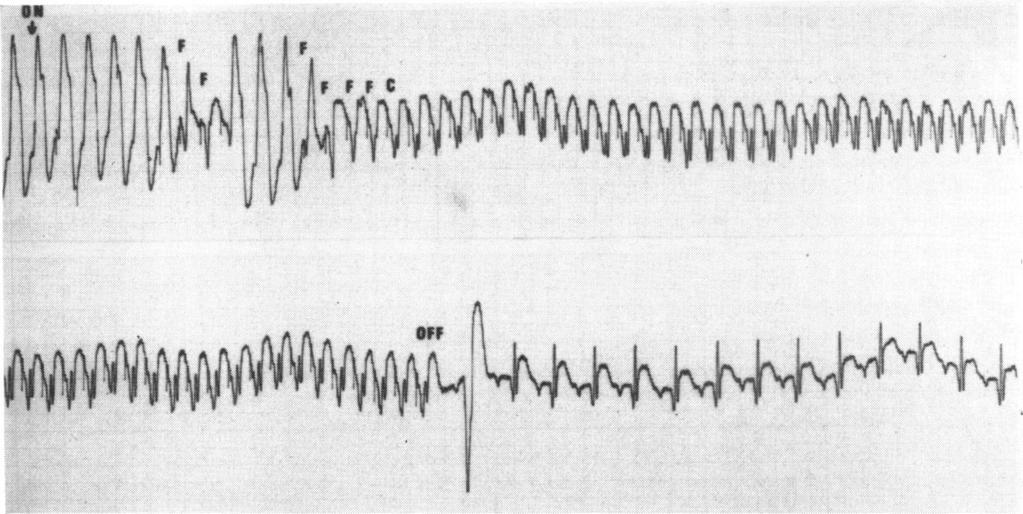 Reversion of ventricular tachycardia by pacemaker stimulation 925 js.li,:i.,,,,,,.,,, FIG. 4 Case 4. Ventricular tachycardia in lead VI.