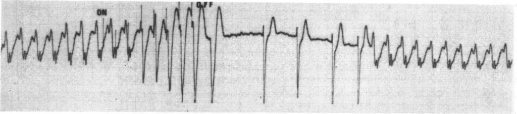After cessation of pacing (off) there is a return of sinus rhythm - the first sinus beat may have been conducted aberrantly. tachycardia (Fig. 5). Ventricular capture was achieved after i 68 seconds.