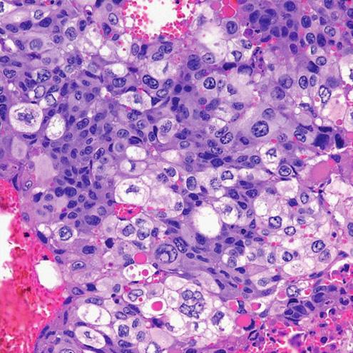 Pathologic Findings in 6 Cases of β-hcg-expressing Pulmonary Carcinoma Microscopic finding Cases Macroscopic