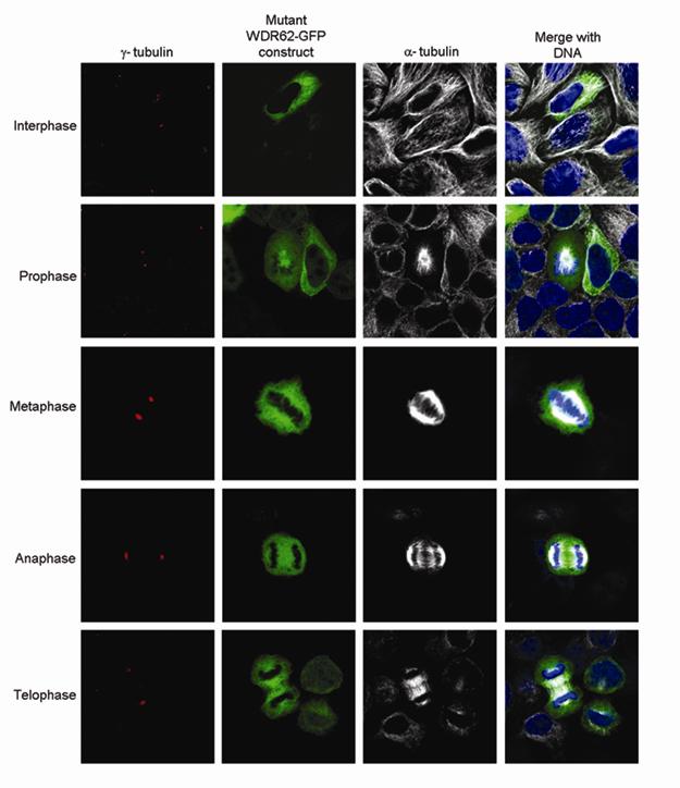 Supplementary Figure 4 Overexpression of WDR62-GFP c.4241dupt mutant construct in HeLa cells. The c.