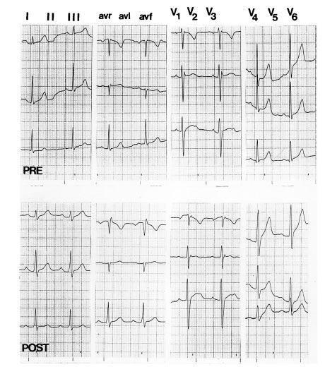 Brugada et al Abnormal ECG and Sudden Death 511 fibrillation who did not have demonstrable structural heart disease but did have an ECG pattern of RBBB and ST-segment elevation in leads V1 to V3.