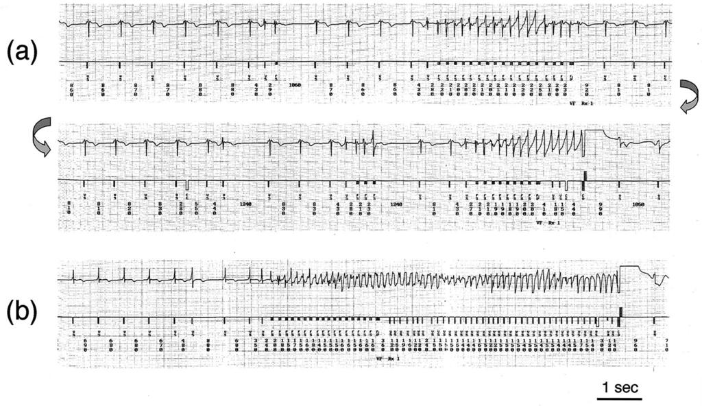 Figure 3. Intracardiac electrogram during pilsicainide-induced ventricular tachycardia by an implantable cardioverter defibrillator in case 9.