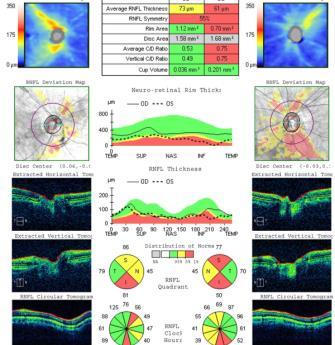 testing Stereo Disc Photos Pachymetry-Pach Optic nerve head (Size, Shape, Health of Rim) Accuracy significantly greater Better detection of disc hemorrhages Cup to Disc Ratio (C.D.) Corneal thickness High IOP s vs.