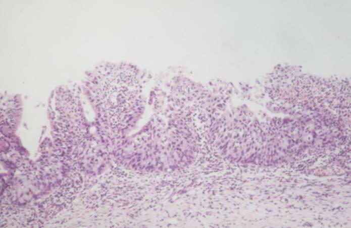 F30 CASE 6 LLETZ for abnormal glandular cells p16