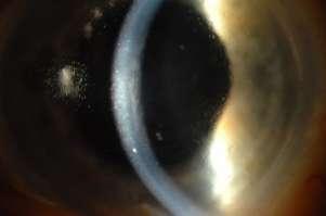 changes in corneal biomechanics because of edema, grafted tissue,
