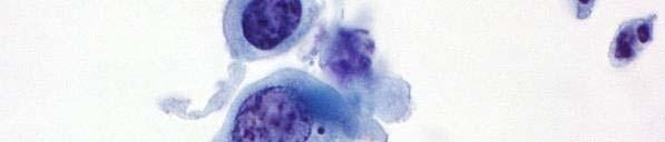 cells from severe dysplasia (HSIL):
