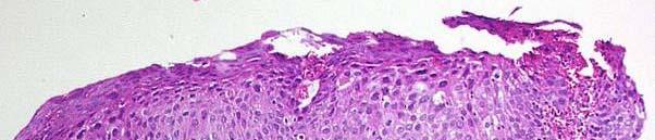 Cervical Intraepithelial Neoplasia Grade 3