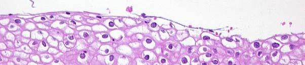 koilocytosis: Fig.