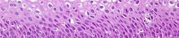 dysplastic cells with