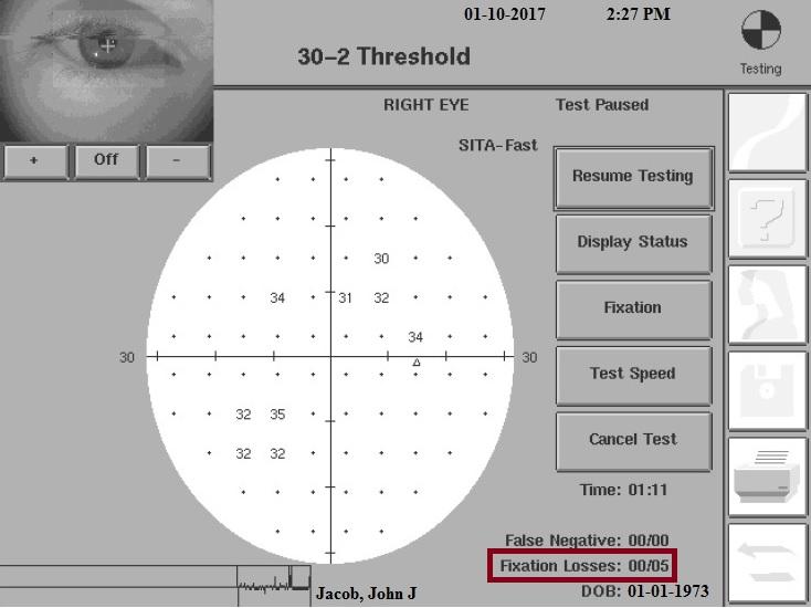 Most Common Visual Field Tests in the CLINIC SPECIALTY TESTS: 10-2 Threshold 10 degrees 68 points Zooms in on macular area PARAMETERS FOR TESTING KEEP THE LIGHTS OFF WHEN YOU START THE HUMPHREY Field