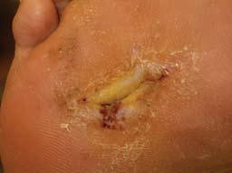 Figure 5. Resolution of ulcer with use of the prefabricated functional insole. Acknowledgements Thank you to Tania Woodrow, Diabetic Specialist Podiatrist, for her help with this study.