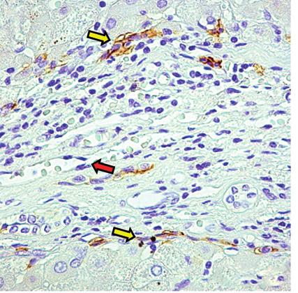 von Willebrand Factor (vwf) in serial sections of liver biopsies of Primary Biliary Cirrhosis (PBC) and