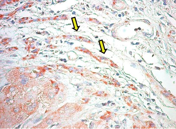 HepatoBiliary Surgery and Nutrition, Vol 2, No 2 April 2013 73 A B C D VEGF-A VEGF-A Figure 4 Immunohistochemistry for