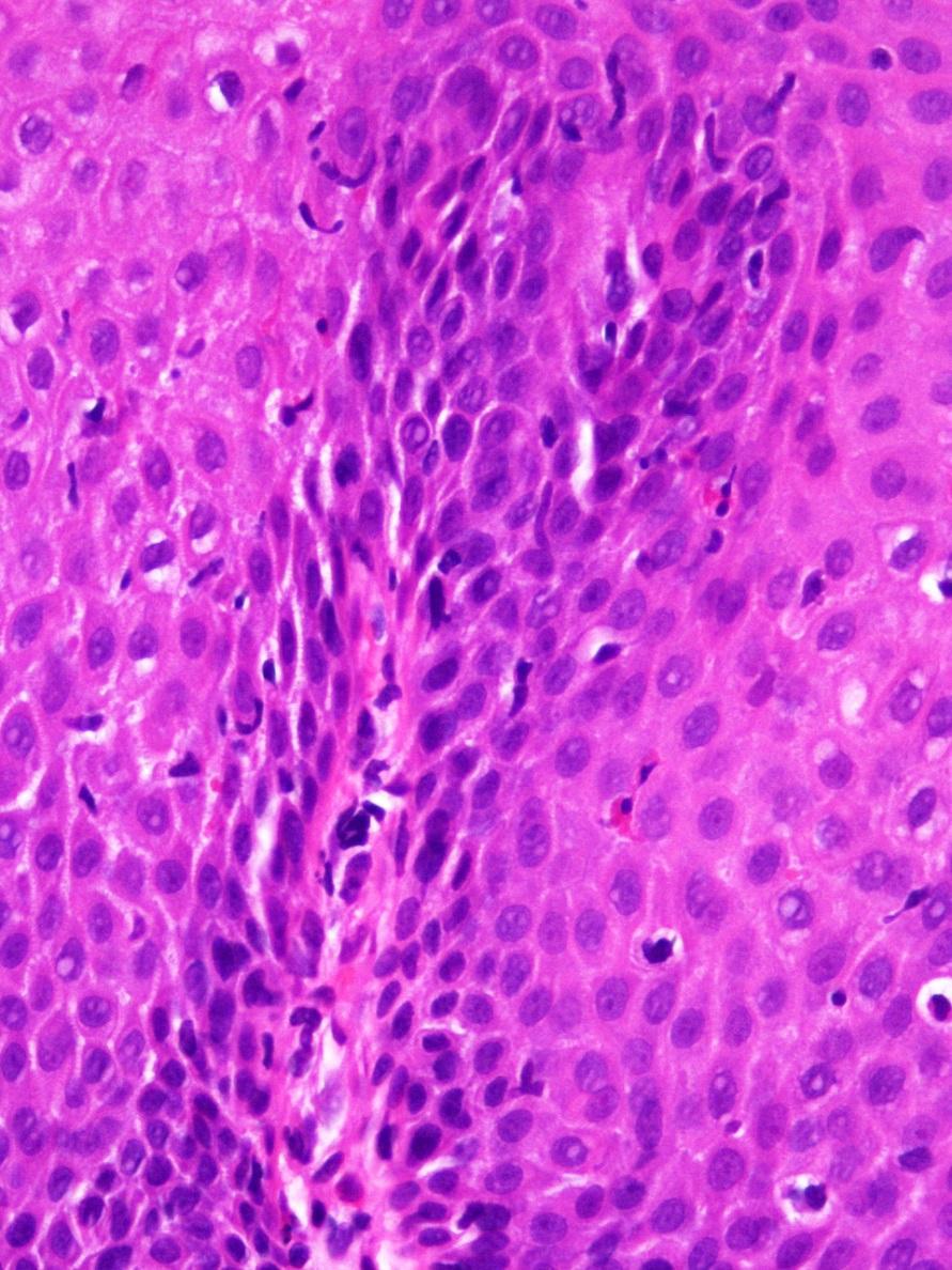 Inflammation - lymphocytes a normal intraepithelial component of the esophageal mucosa, CD8+ T lymphocytes, 10-12 lymphocytes /HPF a round or an irregular nuclear