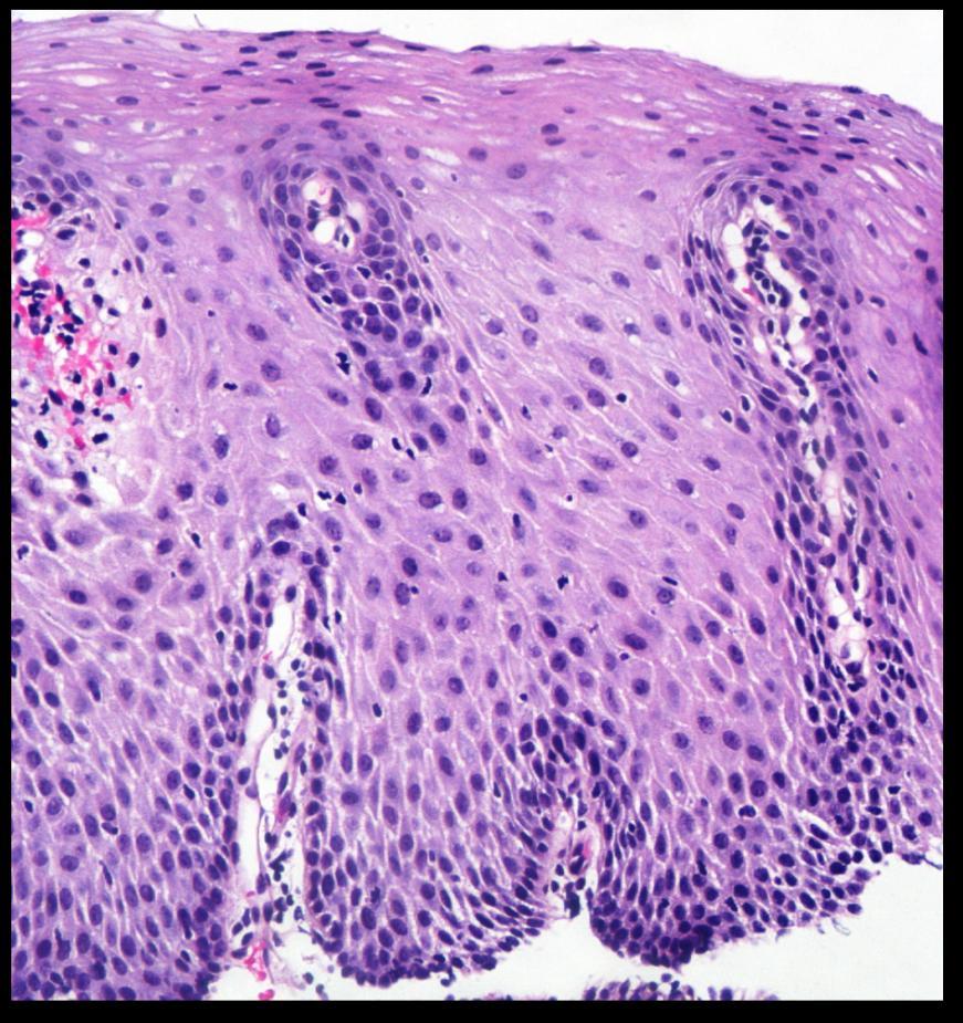 Papillary elongation severe (>75% of total epithelial thickness)