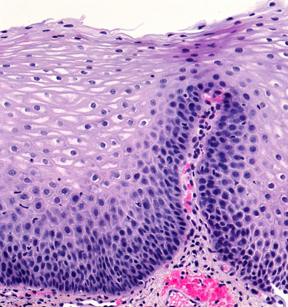 Basal cell layer hyperplasia mild