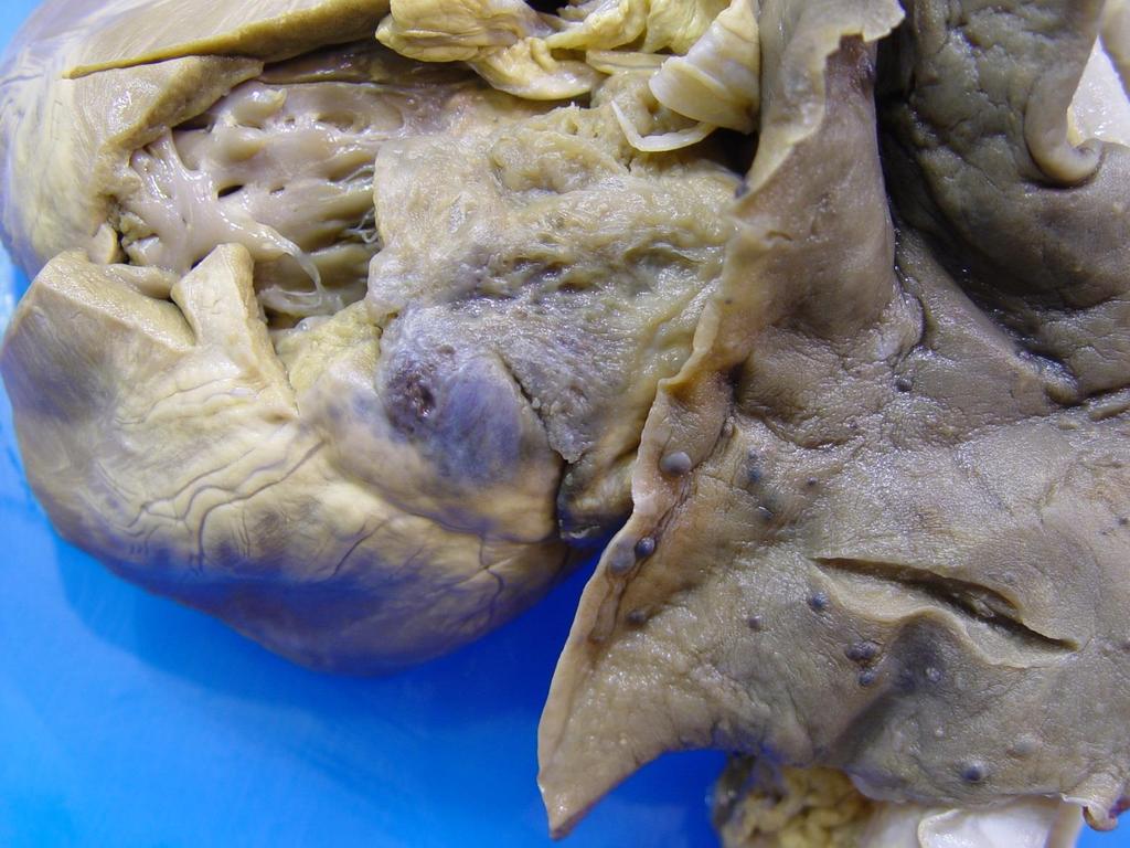 Case 6 Description Scattered randomly throughout the lungs are numerous, small (0.