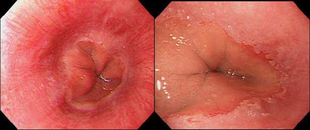 94 Gastroesophageal Reflux Disease between the tops of two mucosal folds. Grade B is one or more mucosal breaks>5 mm long, none of which extends between the tops of two mucosal folds.
