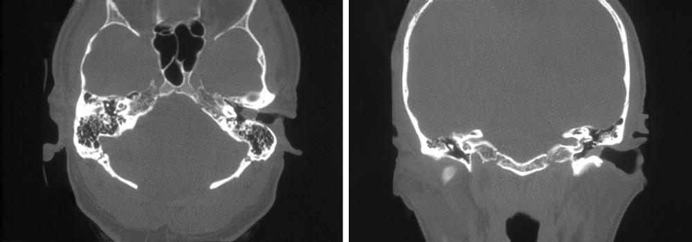 operative staging and planning for an en bloc resection of the temporal bone. It was also suggested that MRI may be a helpful adjunct for determining the soft tissue extent of disease.