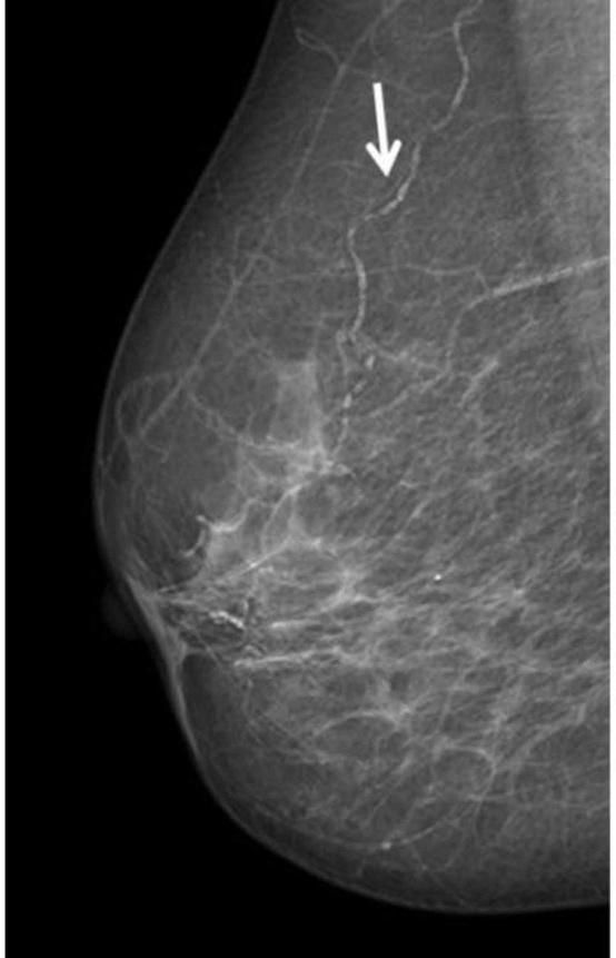 Breast Arterial Calcification and Metabolic Syndrome CLINICS 2014;69(12):841-846 & MATERIALS AND METHODS Study population and design Among 837 consecutive women who had been referred to our radiology
