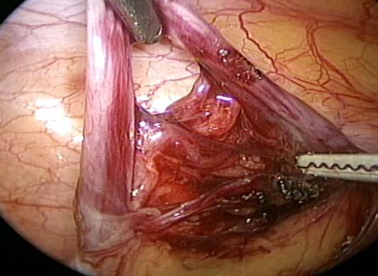 Varicocele in Children and 491 FIG. 1. The process of laparoscopic varicocelectomy. Artery and lymphatics are well identified and saved. TABLE 2.