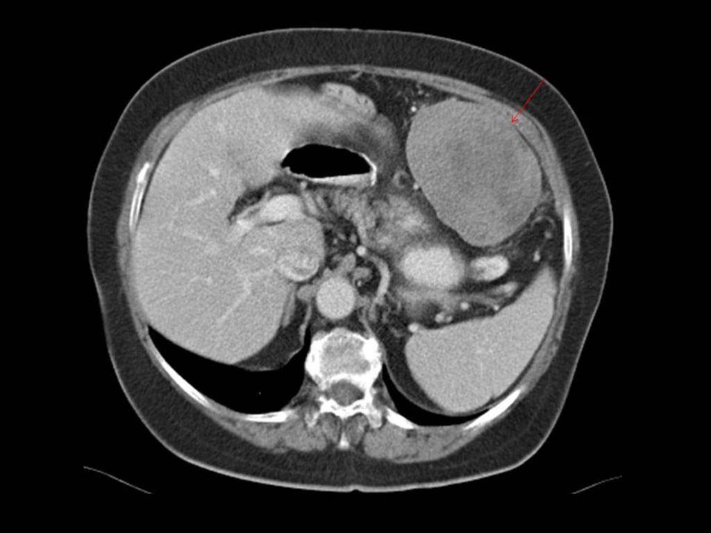 Fig. 2: CT with oral and intravenous contrast.