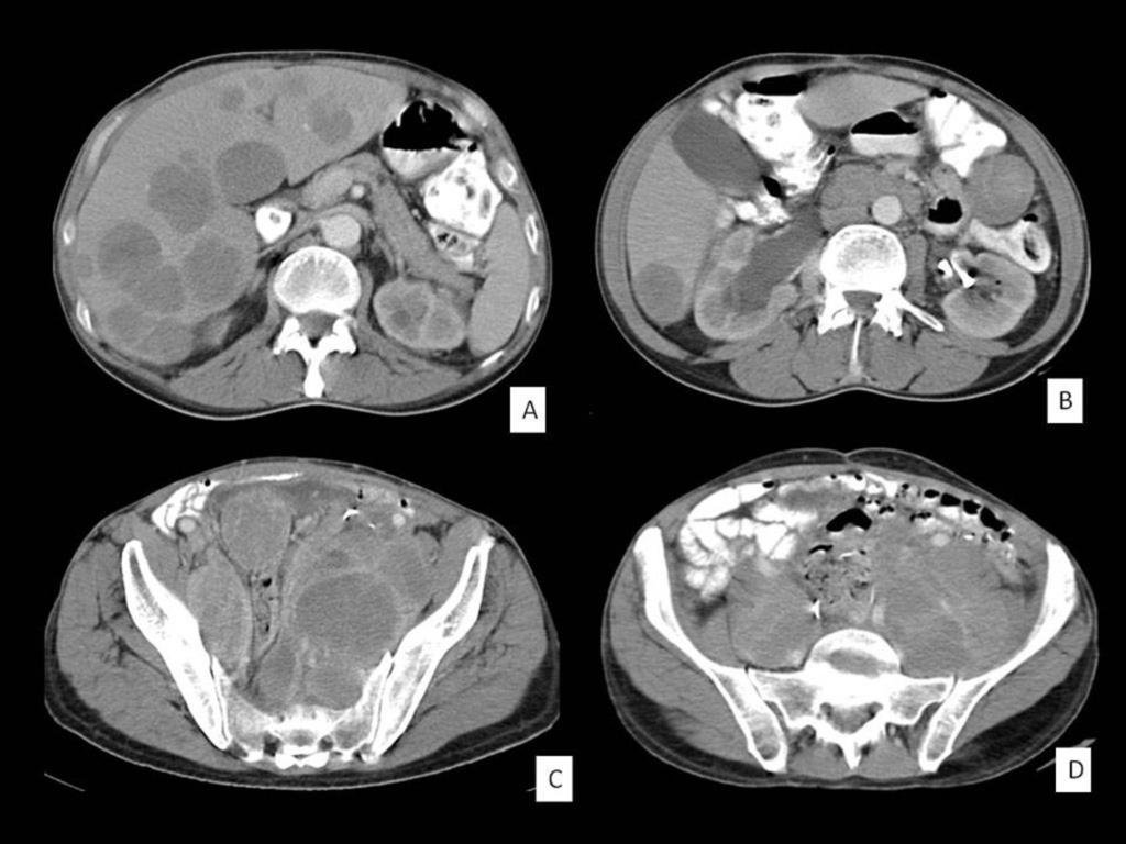 Fig. 3: CT with oral and intravenous contrast. Image A: multiple hypodense hepatic lesions, well defined.