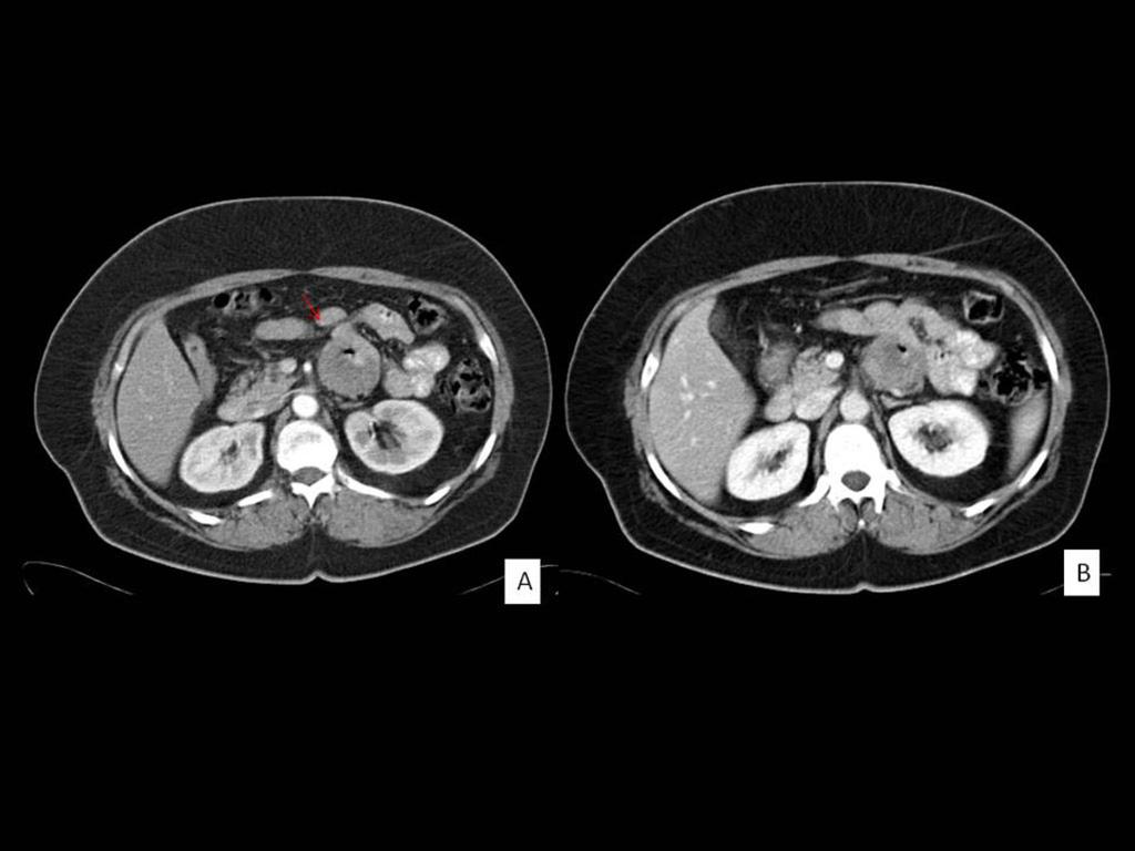 Fig. 5: CT with intravenous and oral contrast, arterial phase (A) and portal (B).