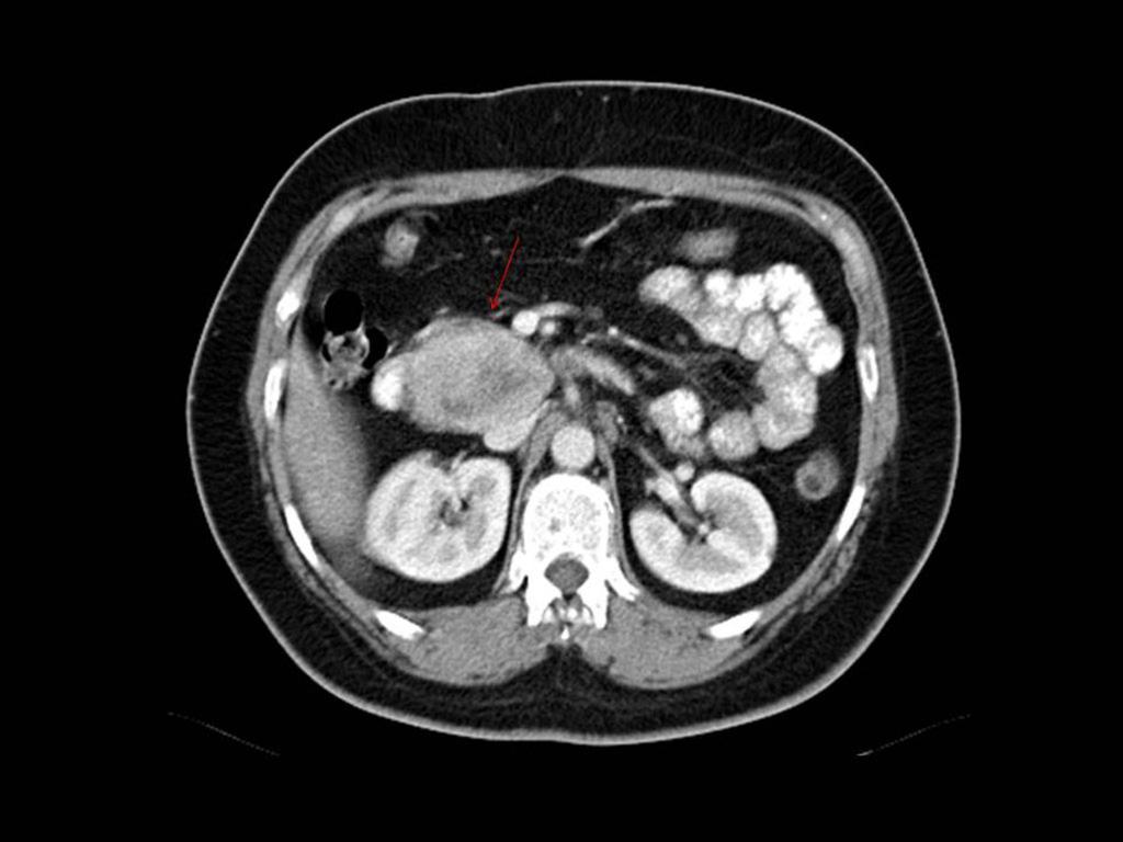 Fig. 6: CT with oral and intravenous contrast.