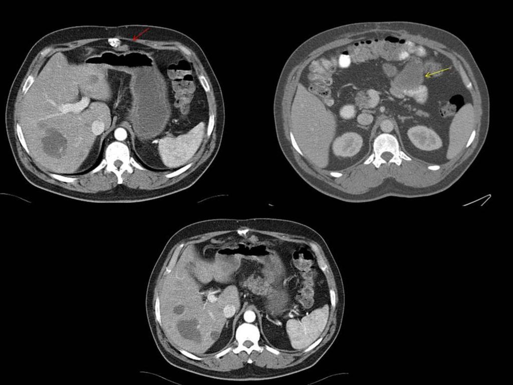 Fig. 7: CT with oral and intravenous contrast. It is appreciated dependent exophytic jejunum wall (yellow arrows), hypodense and well defined.