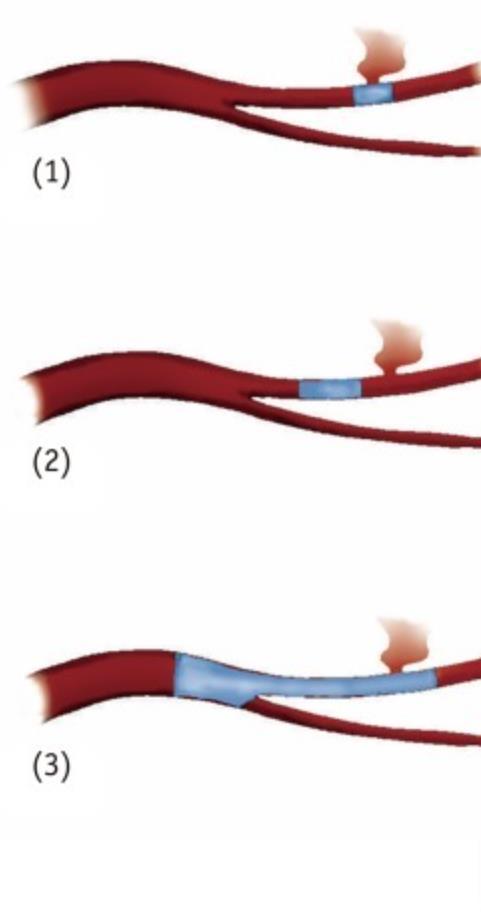 Trans arterial embolization Technique of embolization: Terminal arteries Non terminal arteries Shin JH.