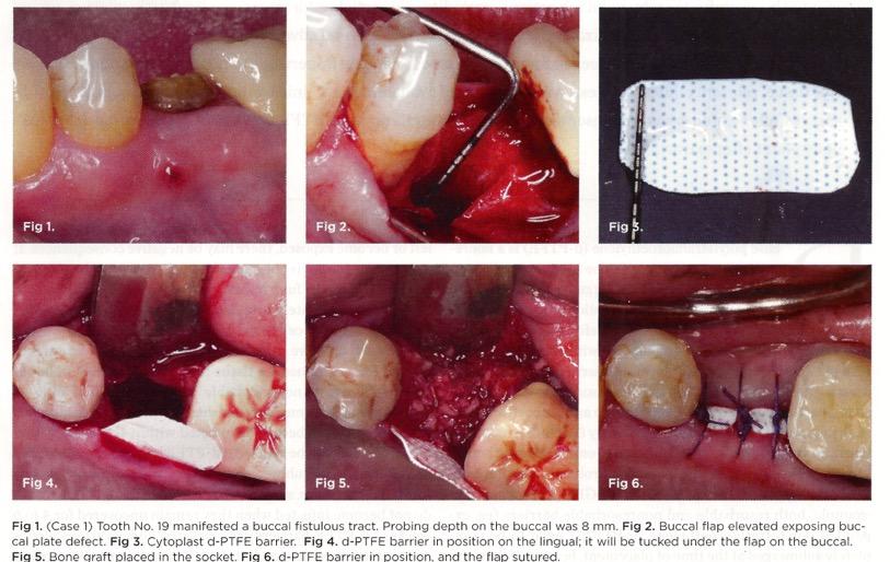preparation For dental implants. Compendium. 36:7 465-472. July/Aug.