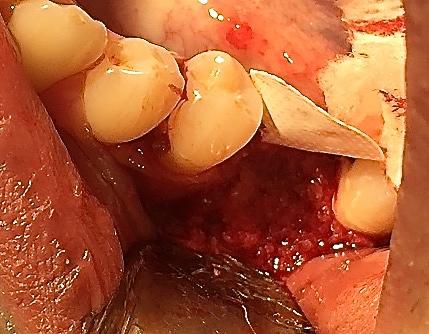 PGA sutures placed. Follow-up with patient and suture removal in 14 days.