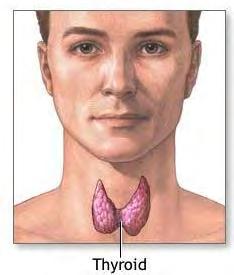 Why is iodine important Iodine deficiency disorders Caused by a lack of thyroid hormone due to inadequate iodine for