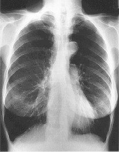 Scenario 1: COPD M/80: 60 pack-year