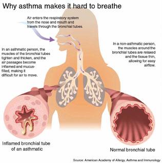 Status asthmaticus: