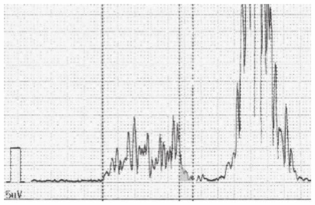 Prediction of AF Recurrence after PVI by P-SAECG 143 Fig. 1. Sample P-wave signal-averaged electrocardiogram P-SAECG trace.