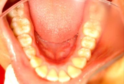 Dental asymmetry was present with a slight deviation of the maxillary dental