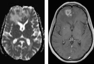 Delayed and late side-effects Pseudoprogression: Increase in or new contrast enhancement on MRI Weeks-months after RT