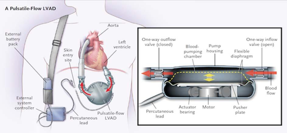 A percutaneous cable, also called the driveline, exits the abdominal wall, connecting the internal pump to the external controller, which is connected to an electrical source (batteries or an