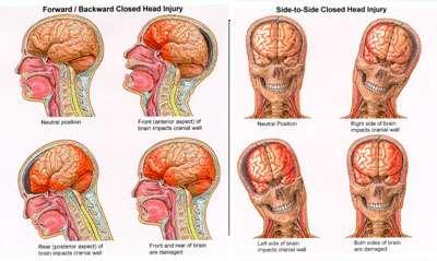brain Bleeding or swelling