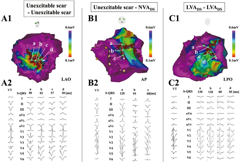Isthmus Channel Mapping-Guided Ablation 1605 Figure 2. DS ablation of the different types of CIs (clitical isthmuses) detected by a pace mapping study.