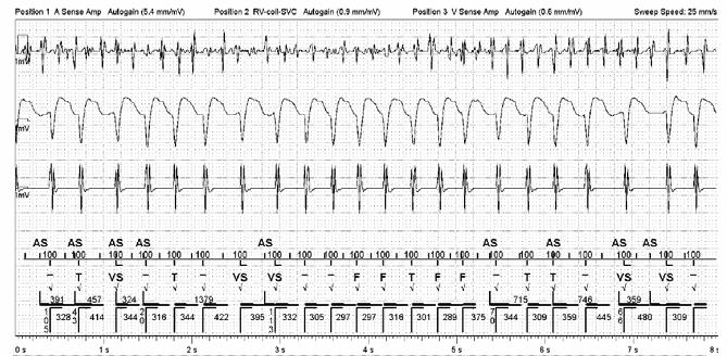 Atrial Fibrillation Chaotic atrial electrical activity with high-rate fibrillatory potentials Irregularly irregular ventricular complexes Rate Control Options Beta blockers Most effective class in